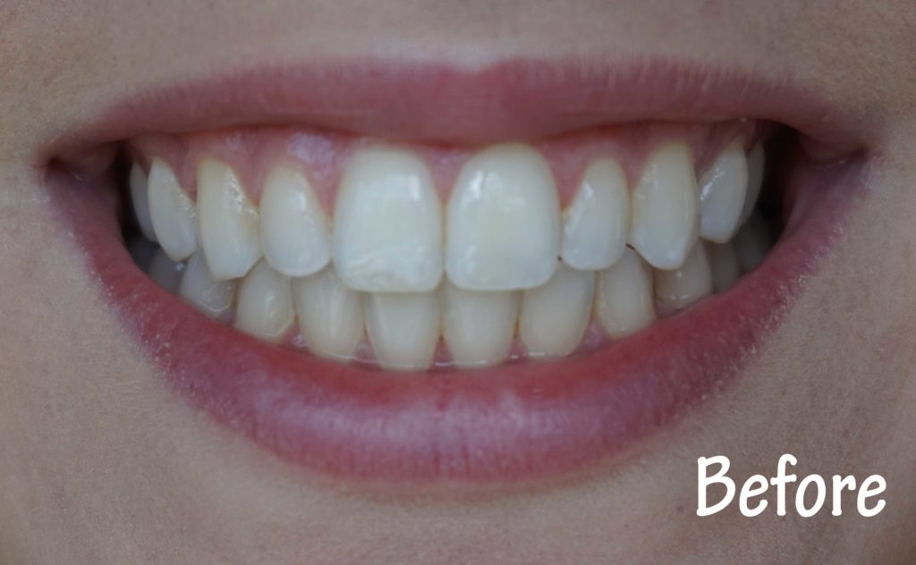 smile brilliant whitening