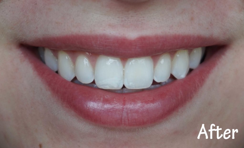 smile brilliant whitening